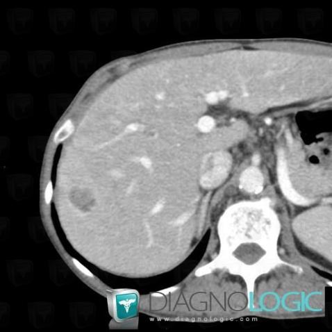 Hepatocellular carcinoma, Liver, CT