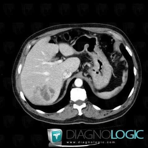 Hepatocellular carcinoma, Liver, CT