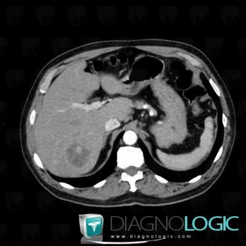 Hepatocellular carcinoma, Liver, CT