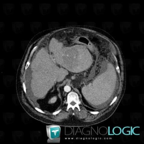 Hepatocellular carcinoma, Liver, CT