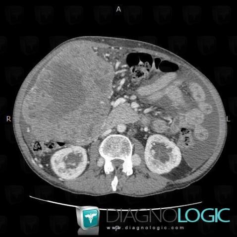 Hepatocellular carcinoma, Liver, CT