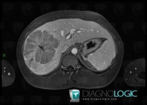 Hepatocellular carcinoma, Liver, MRI