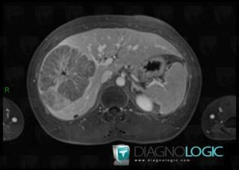 Hepatocellular carcinoma, Liver, MRI