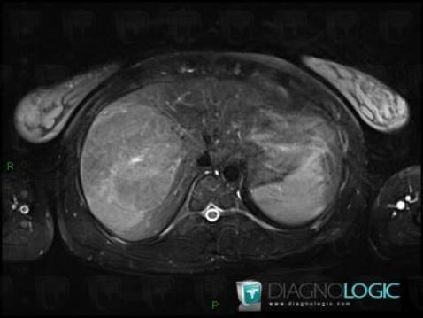 Hepatocellular carcinoma, Liver, MRI