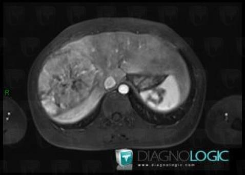 Hepatocellular carcinoma, Liver, MRI