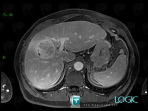 Hepatocellular carcinoma, Liver, MRI