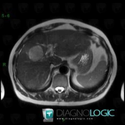 Hepatocellular carcinoma, Liver, MRI