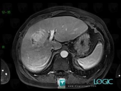 Hepatocellular carcinoma, Liver, MRI