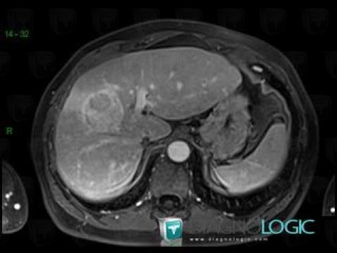 Hepatocellular carcinoma, Liver, MRI