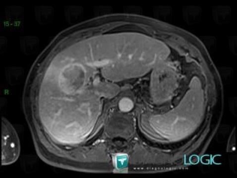 Hepatocellular carcinoma, Liver, MRI