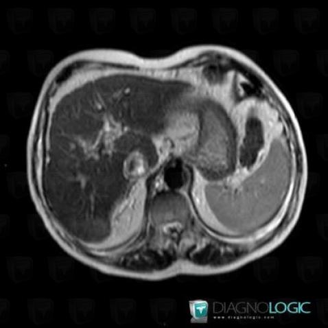 Hepatocellular carcinoma, Liver, MRI