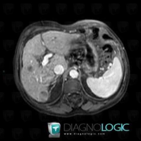 Hepatocellular carcinoma, Liver, MRI