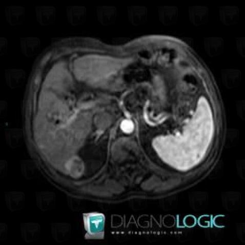 Hepatocellular carcinoma, Liver, MRI