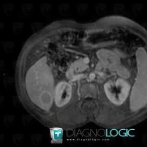 Hepatocellular carcinoma, Liver, MRI
