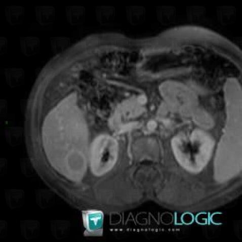 Hepatocellular carcinoma, Liver, MRI