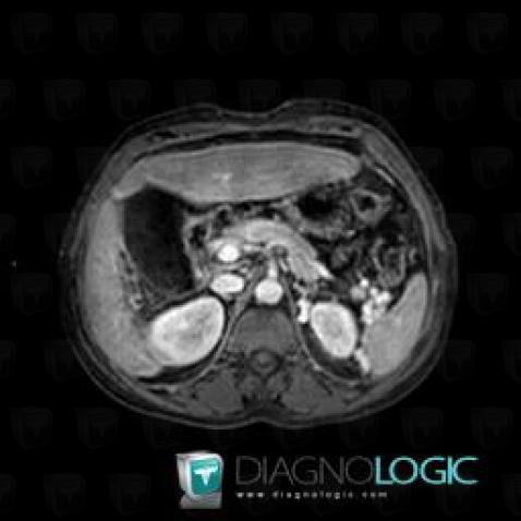 Hepatocellular carcinoma, Liver, MRI