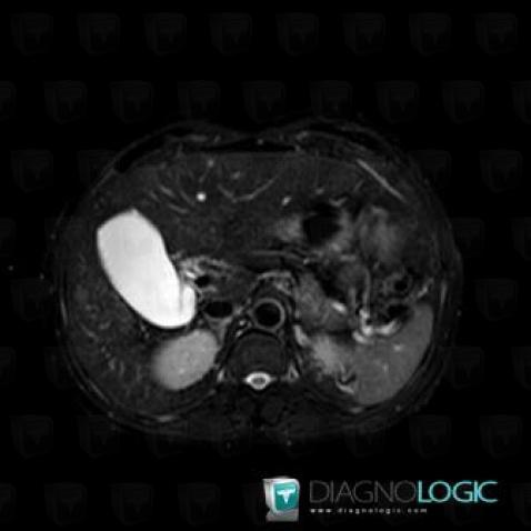 Hepatocellular carcinoma, Liver, MRI