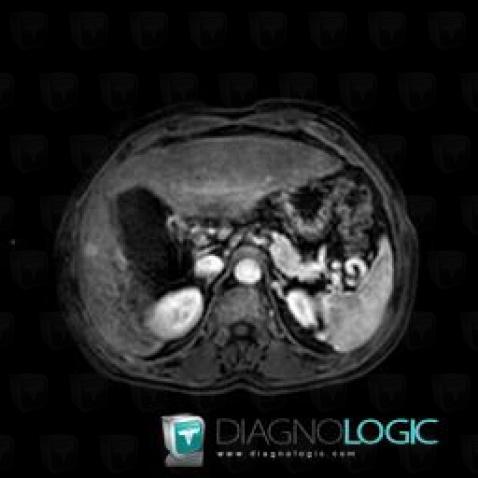 Hepatocellular carcinoma, Liver, MRI