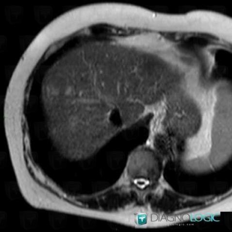 Hepatocellular carcinoma, Liver, MRI