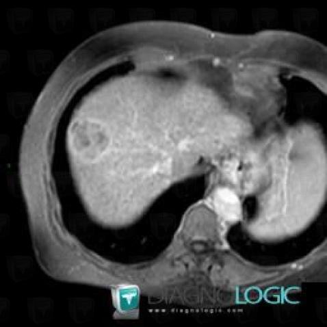 Hepatocellular carcinoma, Liver, MRI