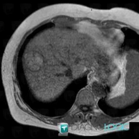 Hepatocellular carcinoma, Liver, MRI