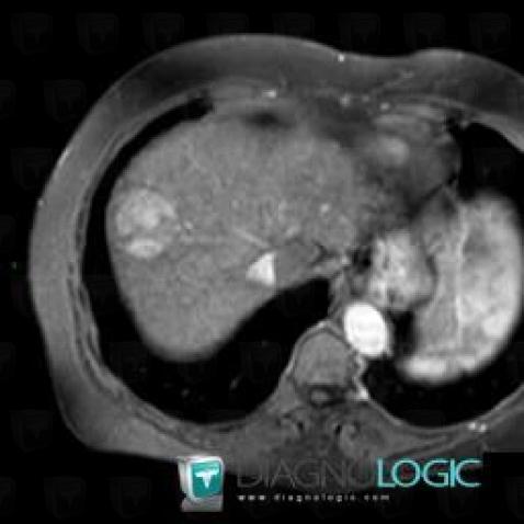 Hepatocellular carcinoma, Liver, MRI