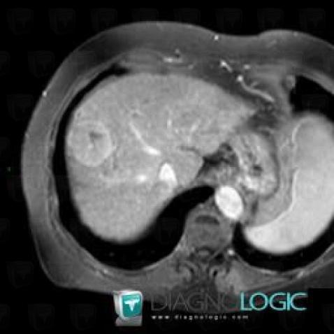 Hepatocellular carcinoma, Liver, MRI