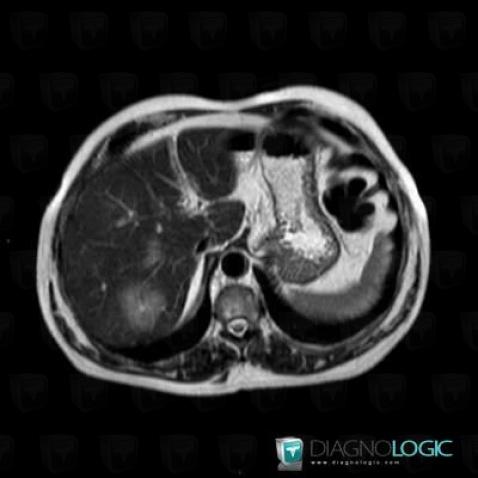 Hepatocellular carcinoma, Liver, MRI