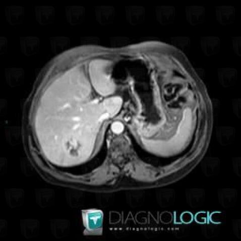 Hepatocellular carcinoma, Liver, MRI