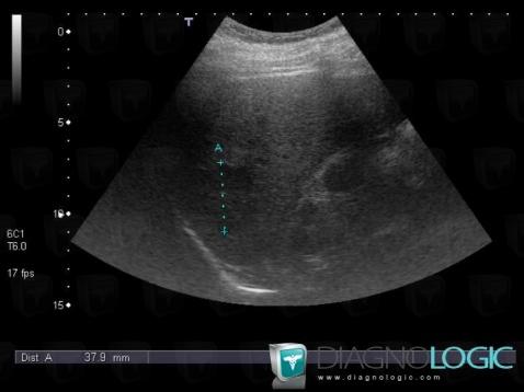 Hepatocellular carcinoma, Liver, US