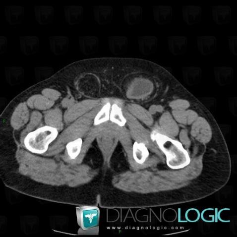 Herniated bladder , Abdominal wall, CT