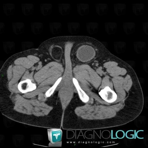 Herniated bladder , Scrotum, CT