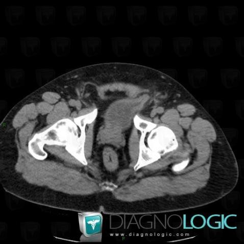 Herniated bladder , Urinary bladder, CT
