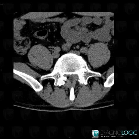 Herniated disc, Vertebral body / Disk, CT