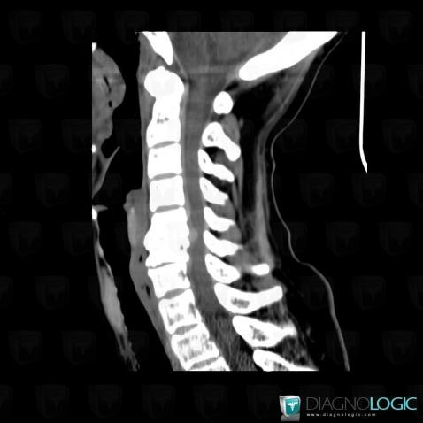 Herniated disc, Vertebral body / Disk, Spinal canal / Cord, CT