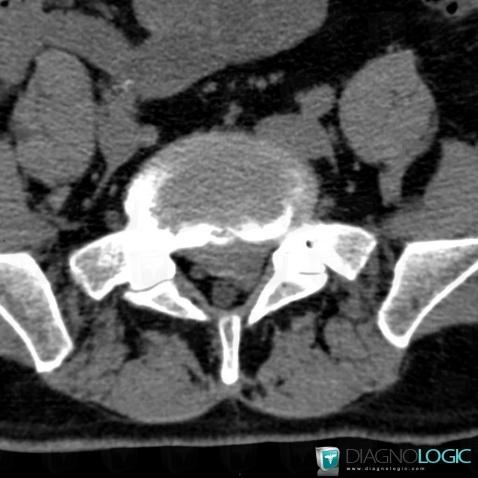 Herniated disc, Vertebral body / Disk, Spinal canal / Cord, CT