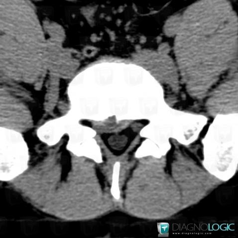 Herniated disc, Vertebral body / Disk, Spinal canal / Cord, CT