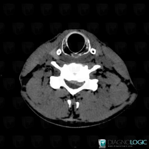 Herniated disc, Vertebral body / Disk, Spinal canal / Cord, CT