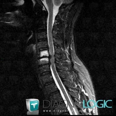 Herniated disc, Vertebral body / Disk, Spinal canal / Cord, MRI