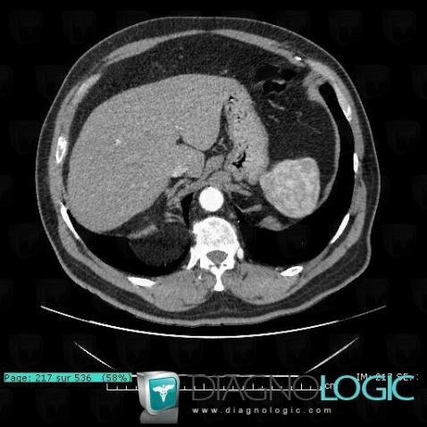 Hernie-Bochdalek, Diaphragme, TDM