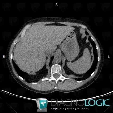 Cas radiologie : Hernie de Bochdalek (Scanner) - Diagnologic