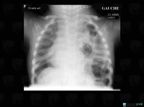 Hernie diaphragmatique , Hile pulmonaire, Médiastin, Radio