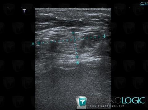 Hernie inguinale, Paroi abdominale, Echographie