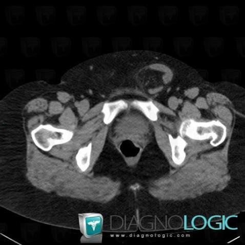 Hernie inguinale, Paroi abdominale, Scanner