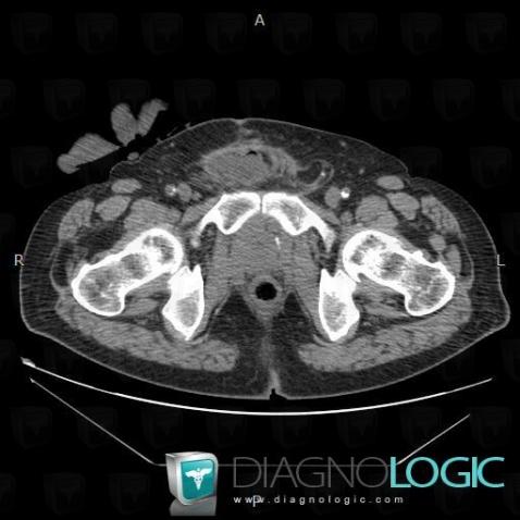 Hernie inguinale, Paroi abdominale, Scanner