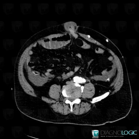 Hernie ombilicale , Paroi abdominale, Scanner