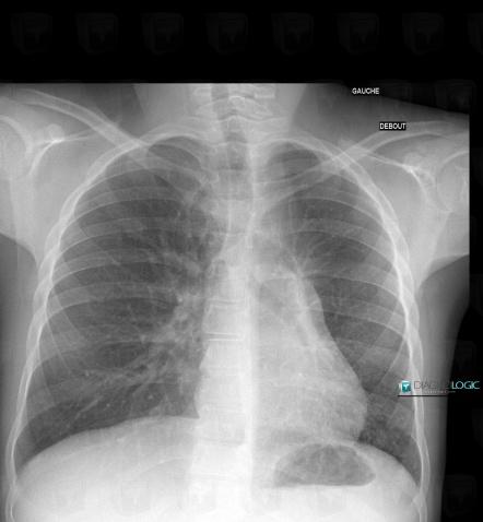 Hernie pulmonaire, Parenchyme pulmonaire, Radio