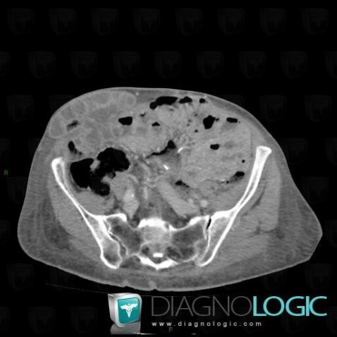 Hernie-Spiegel, Paroi abdominale, Scanner