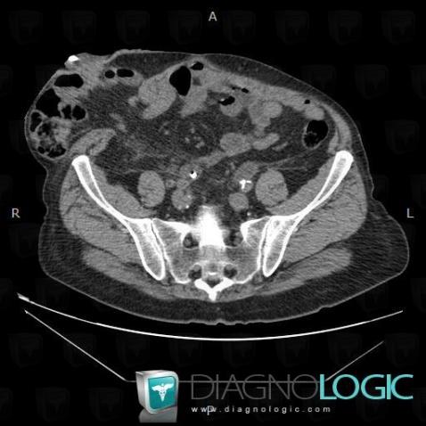 Hernie-Spiegel, Paroi abdominale, Scanner