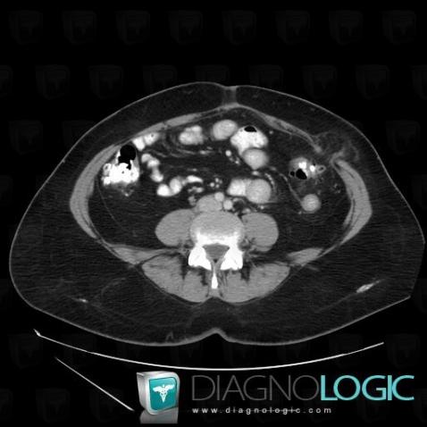 Hernie-Spiegel, Paroi abdominale, Scanner